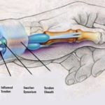 Illustration of texting thumb pain