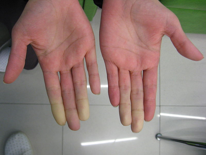 Fingers with low blood circulation