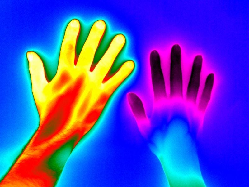 Thermal image of raynaud disease